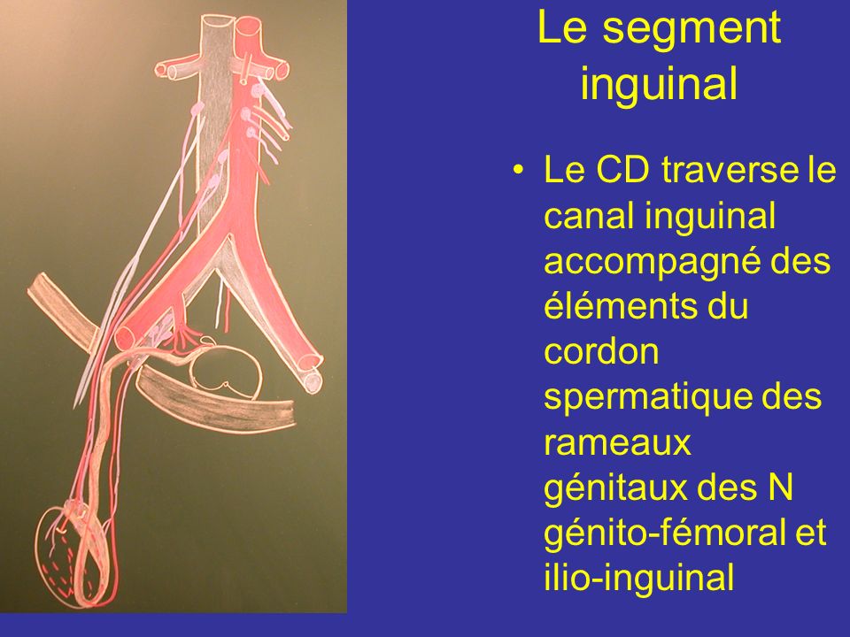 Cordon Spermatique Du Nerf Ilio Inguinal